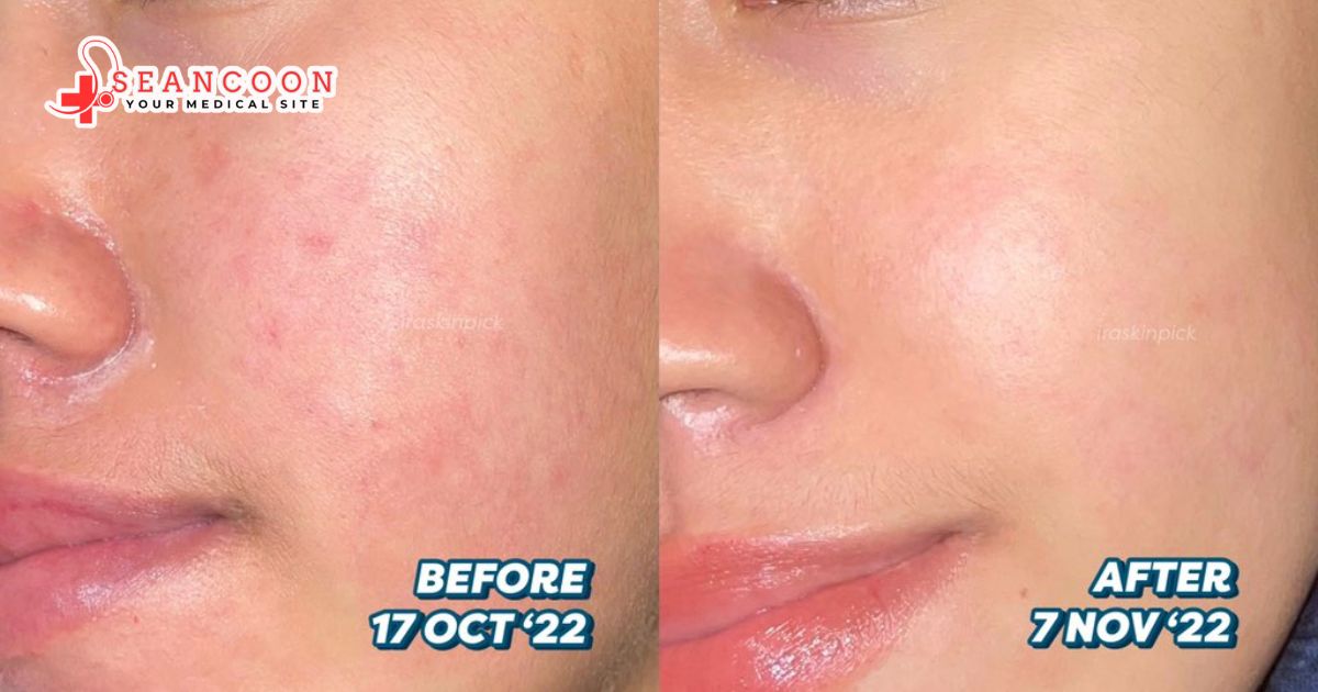 Kulit Mulus Tanpa Jerawat dengan Retinol Wajah sehat dengan kulit mulus tanpa jerawat berkat retinol.