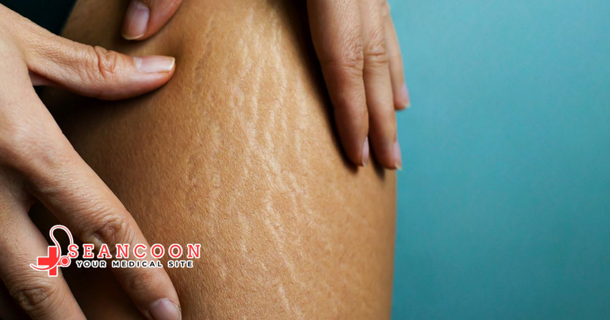 Penghilang Stretch Mark Kulit Lebih Halus penghilang stretch mark bantu samarkan garis kulit