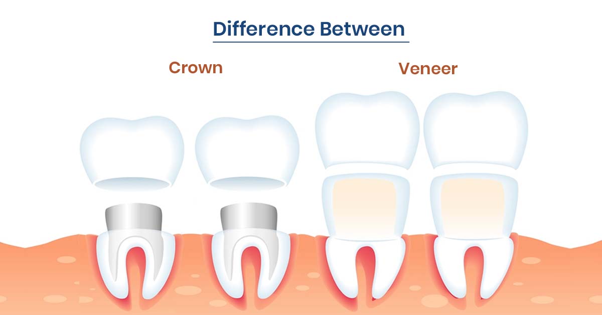 Dental Crown vs Veneer: What’s the Difference and Which Do You Need? Dental Crown vs Veneer